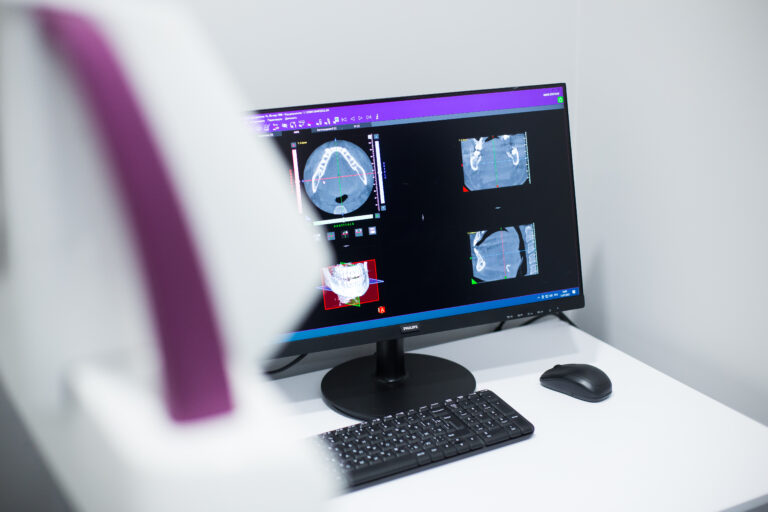 Видалення зуба мудрості у Дніпрі, Кам’янському та Ужгороді